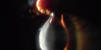 Cornea hydrops in a 15-year-old child with severe keratoconus in both eyes whose education was interrupted due to the disease until resolution of hydrops and she was fit with gas permeable lenses.